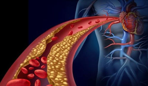 动脉硬化的元凶其实是糖,解除对胆固醇的4个误解