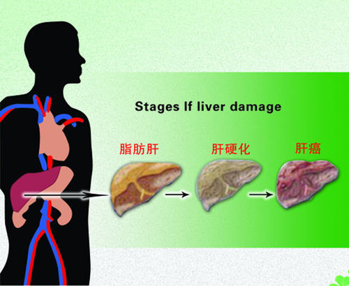 脂肪肝能吃肉吗？得了脂肪肝可不可以吃肉?